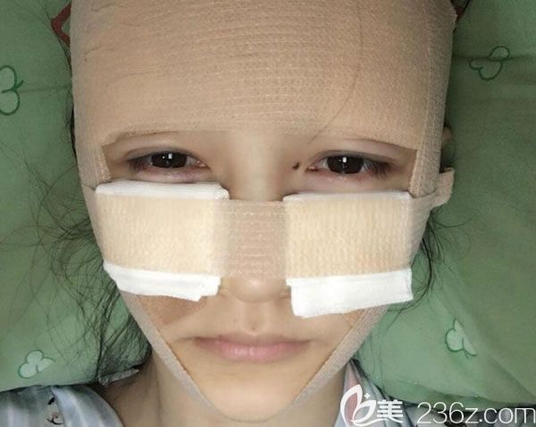 面部自體脂肪填充第2天沒有發(fā)現(xiàn)創(chuàng)傷和切口 面部自體脂肪填充第2天沒有發(fā)現(xiàn)創(chuàng)傷和切口