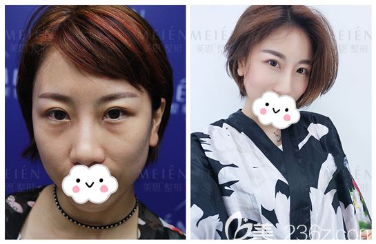 陳宏斌開運鼻整形術后50天案例對比