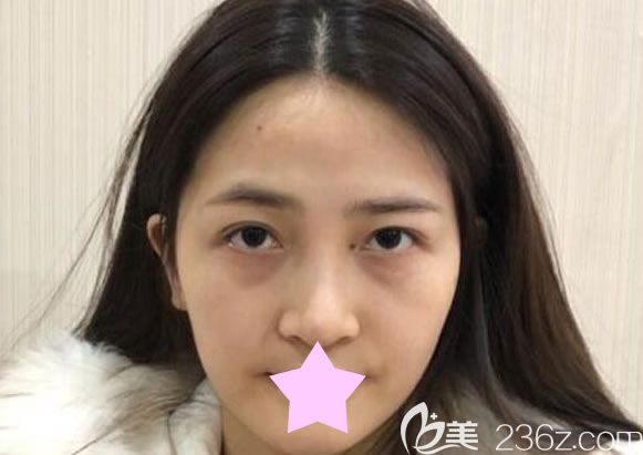 在<!--<i data=20240703-sp></i>-->美萊整形做面部脂肪填充前 在<!--<i data=20240703-sp></i>-->美萊整形做面部脂肪填充前