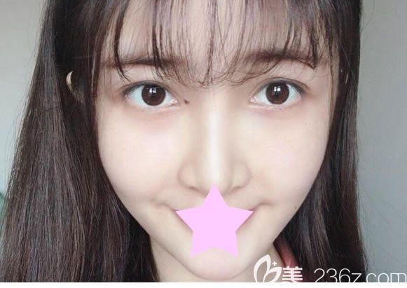 全面部填充七天臉上的注射針眼已經(jīng)結(jié)痂 全面部填充七天臉上的注射針眼已經(jīng)結(jié)痂