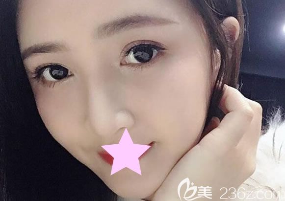 自體脂肪面部填充一個月恢復效果圖 自體脂肪面部填充一個月恢復效果圖