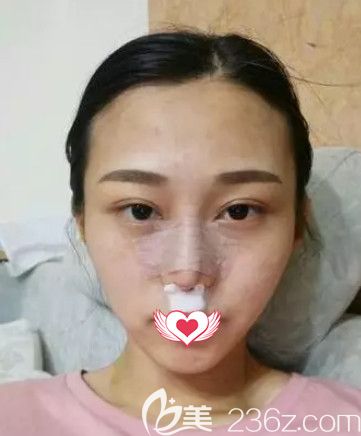 任加偉醫(yī)生為我剛做完隆鼻術(shù)后鼻子微腫