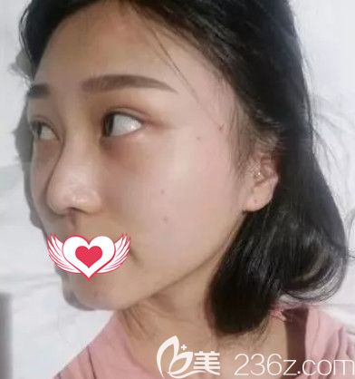 在秦皇島巧致做假體隆鼻術(shù)后7天進(jìn)行拆線