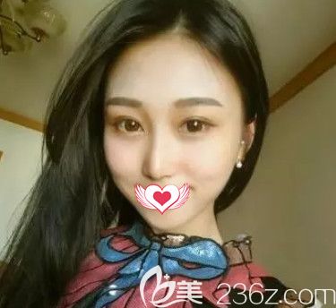 任加偉醫(yī)生為我做硅膠隆鼻18天鼻子完全消腫