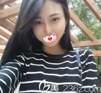 在秦皇島巧致做完硅膠隆鼻術(shù)后1個月 終于擁有我夢寐以求的高挺俏麗自然鼻