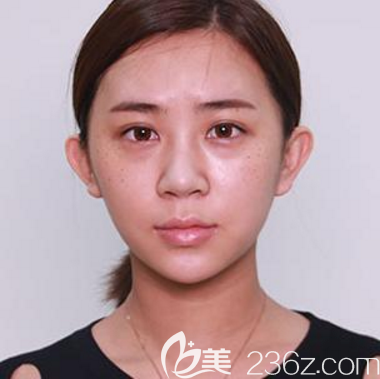 深圳鵬程醫(yī)院隆鼻案例術(shù)前照片 深圳鵬程醫(yī)院隆鼻案例術(shù)前照片