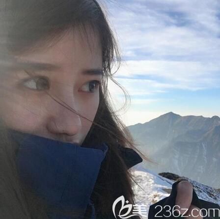 肋軟骨隆鼻術(shù)后2個月美照 肋軟骨隆鼻術(shù)后2個月美照