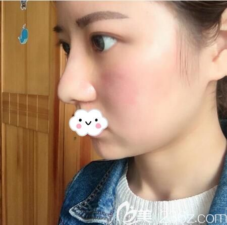 鼻綜合手術(shù)7天恢復(fù)效果 鼻綜合手術(shù)7天恢復(fù)效果