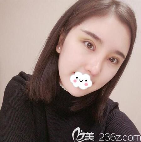 楊建雙眼皮術(shù)后7天恢復(fù)效果 楊建雙眼皮術(shù)后7天恢復(fù)效果