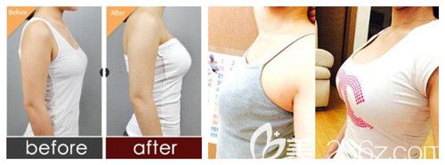 賈顏鋒醫(yī)生做隆胸案例