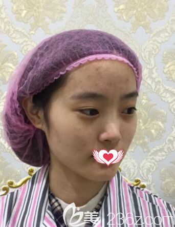 韋杰醫(yī)生做隆鼻術(shù)前鼻子塌平 韋杰醫(yī)生做隆鼻術(shù)前鼻子塌平