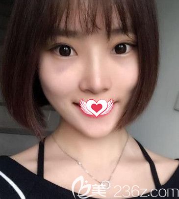 韋杰醫(yī)生為我做假體隆鼻術(shù)后16天鼻子消腫 韋杰醫(yī)生為我做假體隆鼻術(shù)后16天鼻子消腫