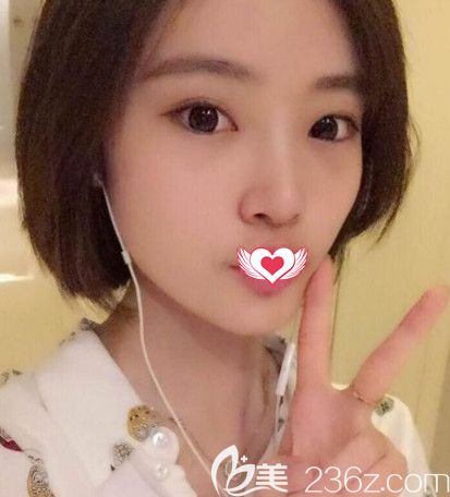 都說(shuō)我找韋杰醫(yī)生做硅膠隆鼻手術(shù)效果自然立體 你們覺(jué)得怎么樣