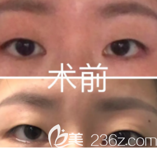 小姐姐術(shù)前雙眼皮的樣子