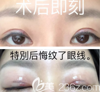 術(shù)后即刻做完雙眼皮的時(shí)候