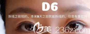 術(shù)后第六天的眼部