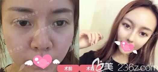 成都恒博半肋軟骨隆鼻前后對(duì)比