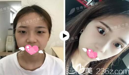 美容醫(yī)院雙眼皮術(shù)后效果