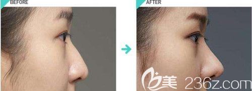 馬志丹做鼻綜合案例