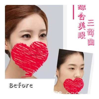 無錫施爾美雙眼皮案例