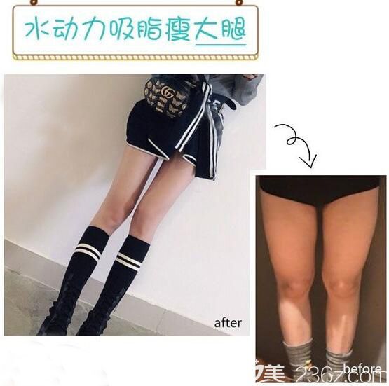 無錫施爾美水動力吸脂