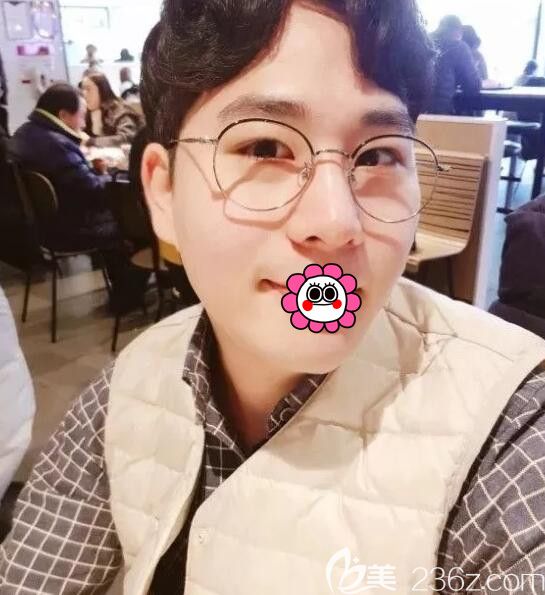 被朋友嘲笑眼睛像天狼星一樣小，于是找韓國BK整形李丙濬院長做了雙眼皮和鼻整形術(shù)