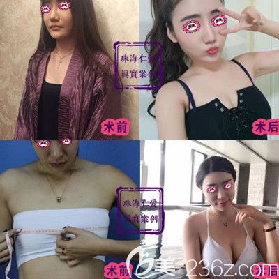 珠海仁愛艾先新隆胸對比圖