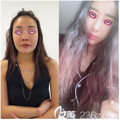 珠海仁愛整形隆鼻效果圖