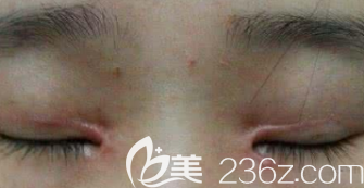 雙眼皮術(shù)后疤痕增生的樣子