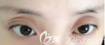 雙眼皮術(shù)后三層和過寬的案例