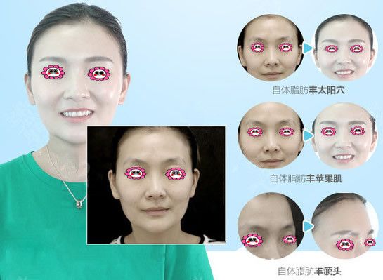 曹洪揚(yáng)院長(zhǎng)自體脂肪填充效果圖