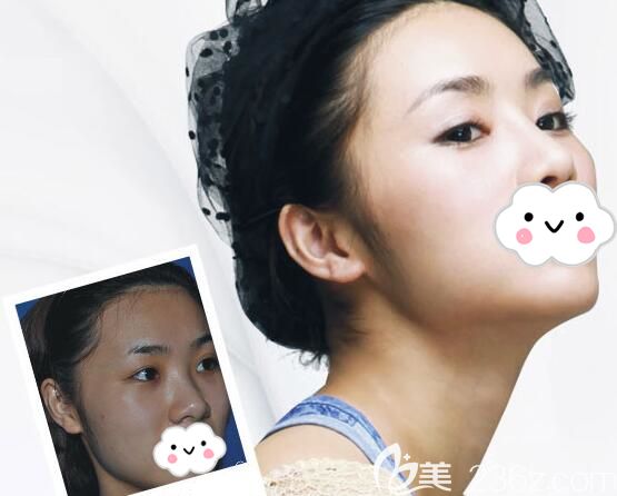 主任做假體隆鼻88天后恢復(fù)