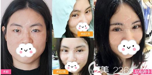 林登文主任做韓式雙眼皮手術(shù)恢復(fù)效果