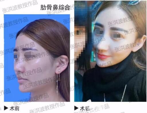 張洪波醫(yī)生隆鼻前后對比案例