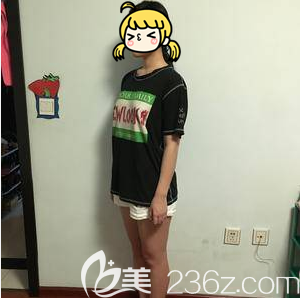 在北京藝星做大腿吸脂前樣子 在北京藝星做大腿吸脂前樣子