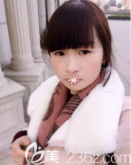 趙蓉激光祛雀斑術(shù)后3個月