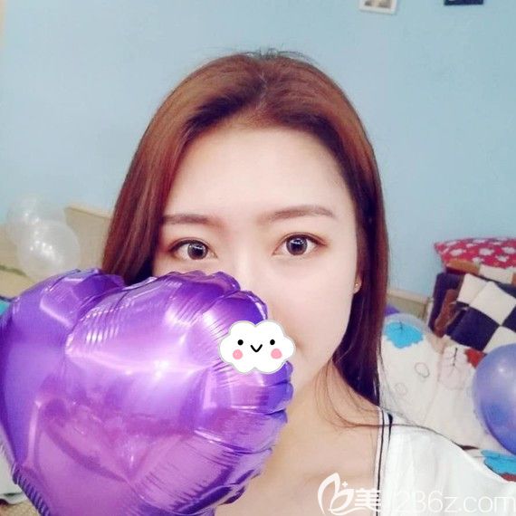 荊州華美李杰埋線雙眼皮術(shù)后1月恢復(fù)照片
