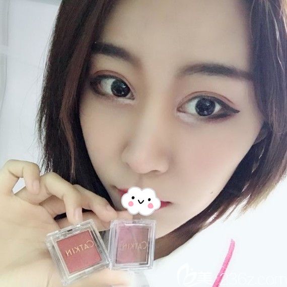 天生一單一雙找荊州華美醫(yī)療美容李杰做埋線雙眼皮后像媽媽生的一樣自然