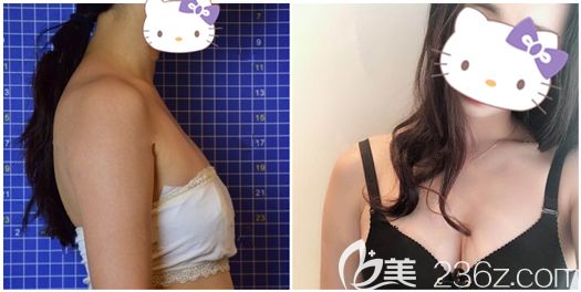 金輝院長做假體隆胸手術(shù)恢復(fù)效果