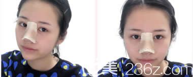 我在柳州華美做雙眼皮和鼻綜合術(shù)后第3天 我在柳州華美做雙眼皮和鼻綜合術(shù)后第3天