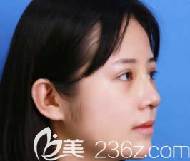 我在柳州華美做眼鼻部綜合整形第7天 我在柳州華美做眼鼻部綜合整形第7天