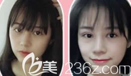 柳州做雙眼皮哪里好?上傳我在華美整形做7MM全切雙眼皮+鼻綜合隆鼻后28天恢復(fù)過程圖