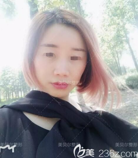 23歲的年紀38歲的臉，面診蘇州美貝爾醫(yī)生李志勇填充脂肪后告別面部凹陷衰老及法令紋