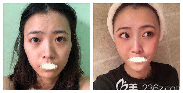 銅雀臺雷剛主任自體脂肪全面部填充術(shù)后15天效果對比