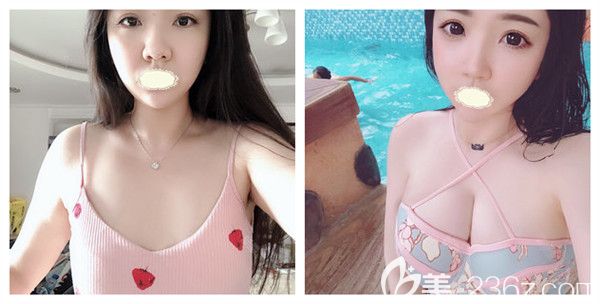 成都銅雀臺雷剛醫(yī)生假體隆胸術(shù)后真實案例對比效果展示