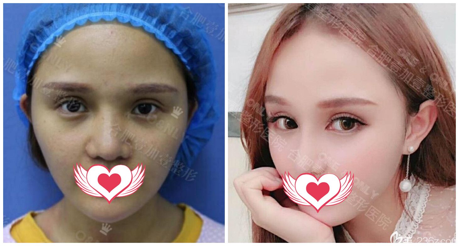 合肥壹加壹醫(yī)院怎么樣？壹加壹<!--<i data=20240703-sp></i>-->開外眼角案例效果一覽