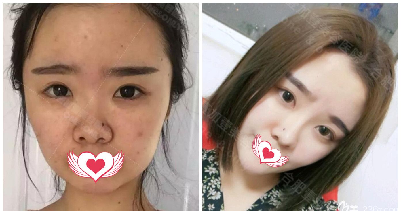 合肥壹加壹整形好嗎？公布壹加壹<!--<i data=20240703-sp></i>-->鼻綜合+膨體隆下巴真人案例