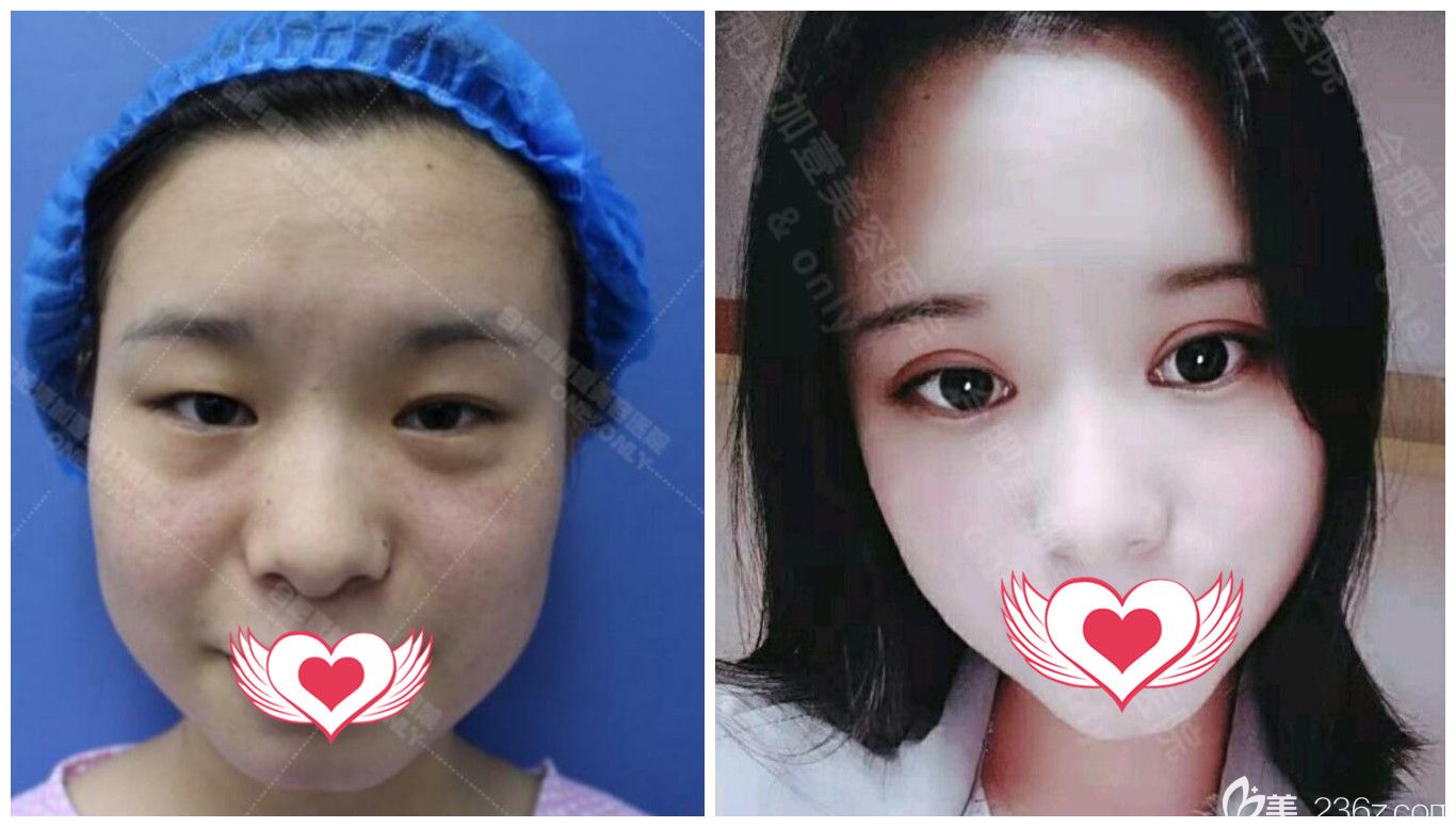 合肥壹加壹整形可以嗎？來看壹加壹高影眼綜合整形案例效果對(duì)比