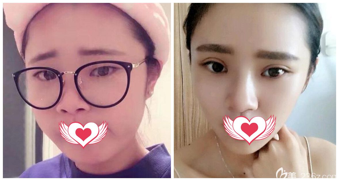 合肥壹加壹孟松雙眼皮好嗎？孟松雙眼皮案例效果圖來驗(yàn)證