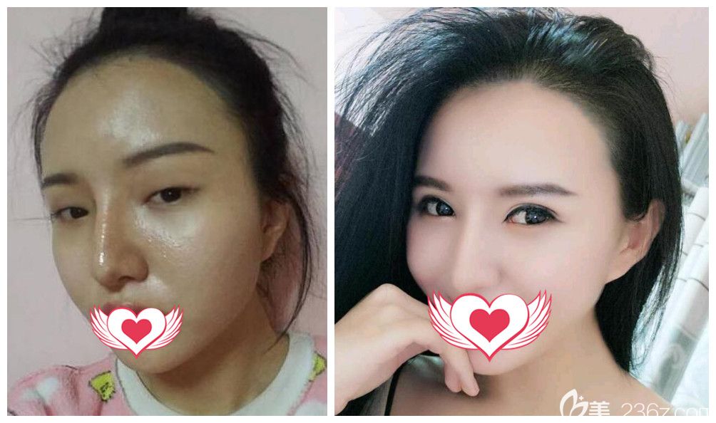 合肥壹加壹正規(guī)嗎？壹加壹甘泉涌玖度美眼眼綜合案例證明實(shí)力